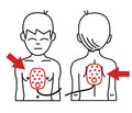 Placement of AED Pads on Infants