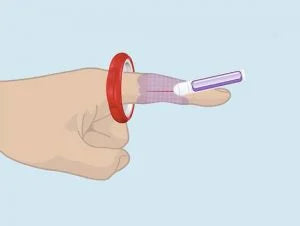 Step 4: Easily removing the T-Ring after bleeding is controlled, without the need for cutting or manual loosening, ensuring a safe and painless process.