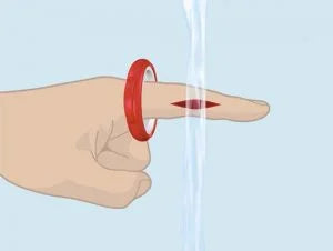 Step 2: Positioning the T-Ring just above the wound to ensure effective pressure is applied for optimal bleeding control.